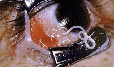 Tipos de parasitos no corpo humano