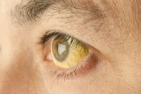 Amareleamento do branco dos ollos